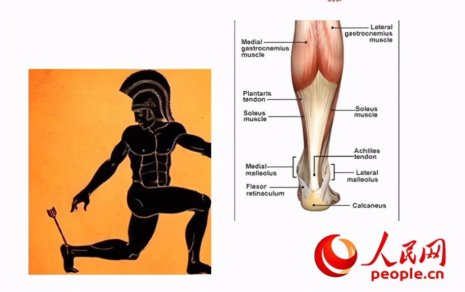 踢足球时突然感觉足跟剧痛?可能是跟腱断了