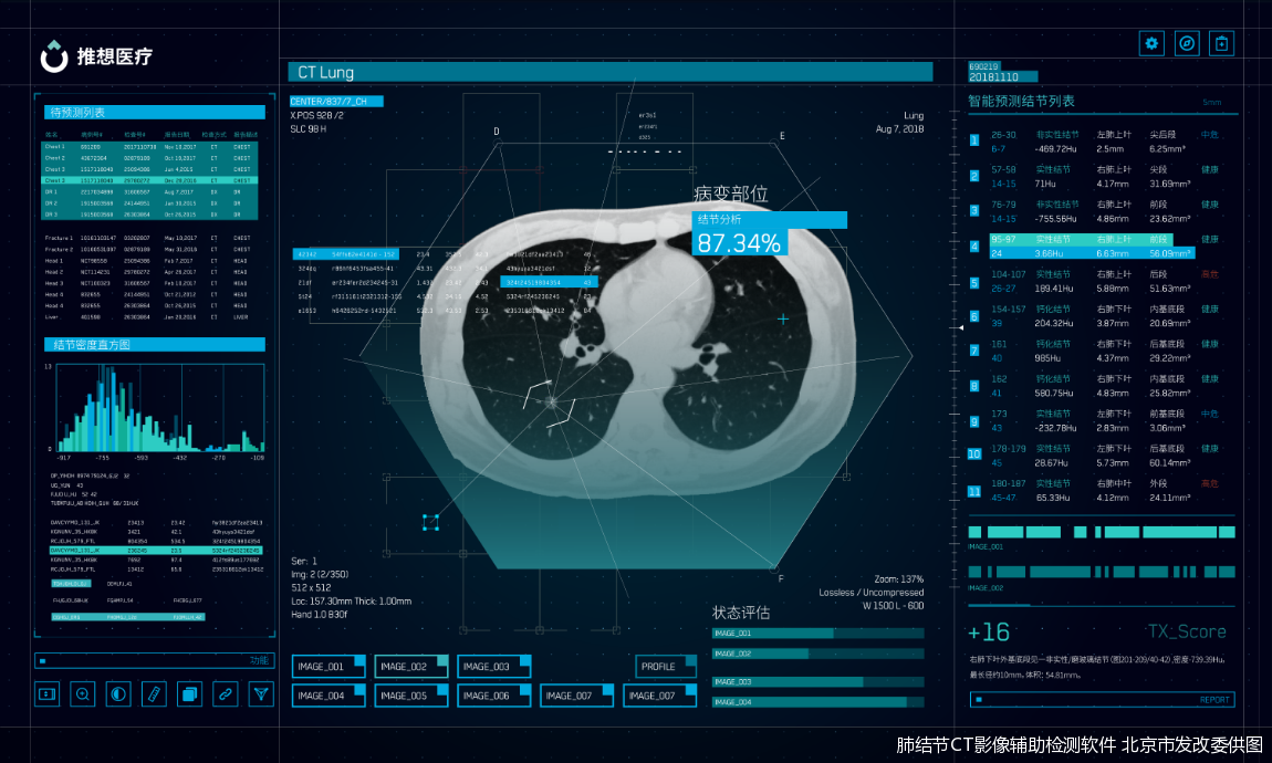 肺结节ct影像辅助检测软件 北京市发改委供图