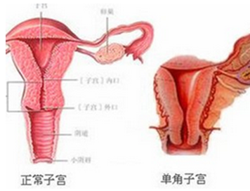 子宫畸形有六种情况,有的直接影响你怀孕!