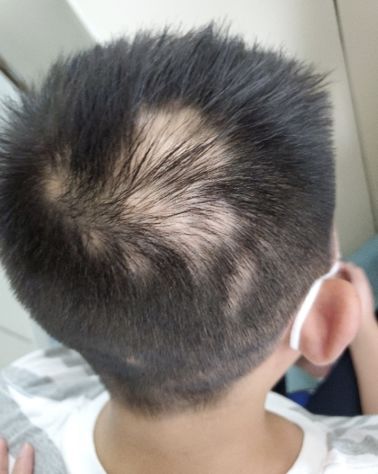 高考临近杭州一考生和妈妈同时患上斑秃