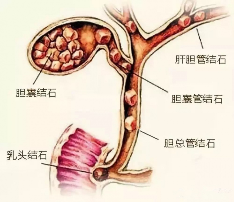 春来百病起,胆结石疼痛,不适该怎么办?