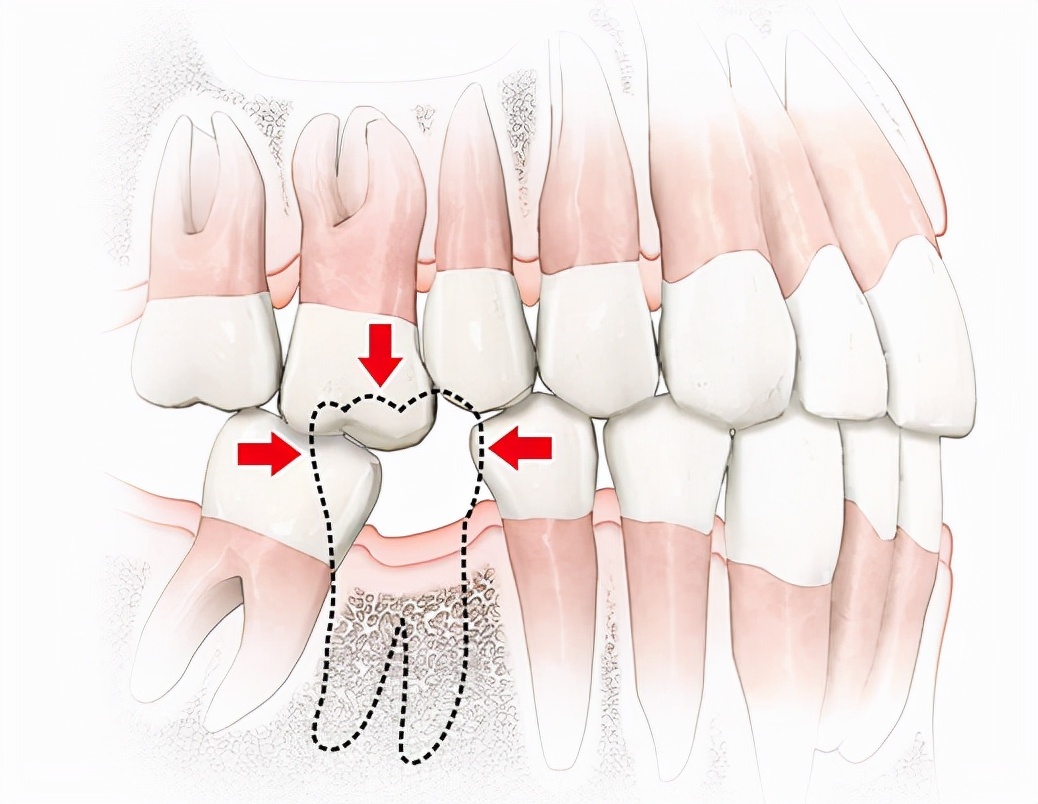 另外 缺牙位置的对颌牙会因为没有咬合关系,会逐渐向对口伸长,使咬合