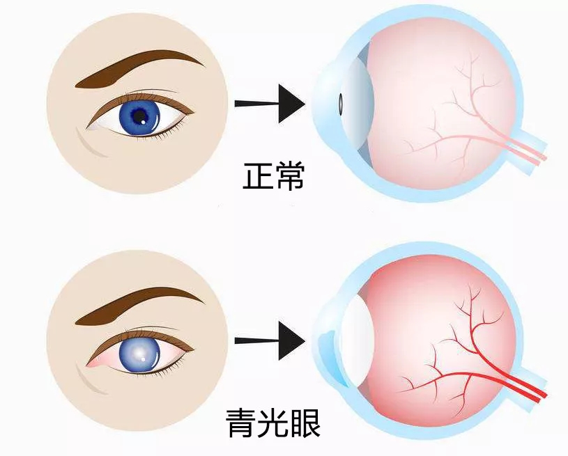 青光眼的致盲率高达30%!快来看看你是否属于高危人群__凤凰网