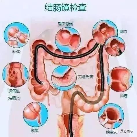 贴心医生67做一次肠镜到底管几年不得癌