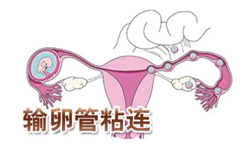 输卵管造影疼吗?做完多久可以要孩子?你想问的这里都有答案!