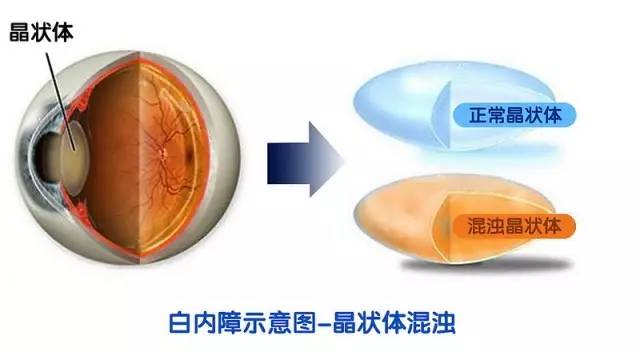 白内障越来越年轻化了__凤凰网