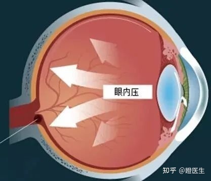 一招教你 在家也能测眼压__凤凰网