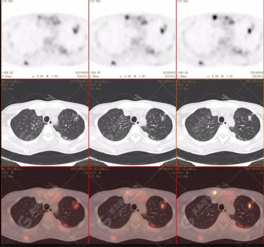 男子腰痛误以为是骨转移,pet-ct"鹰眼透视"一查,原来是结核