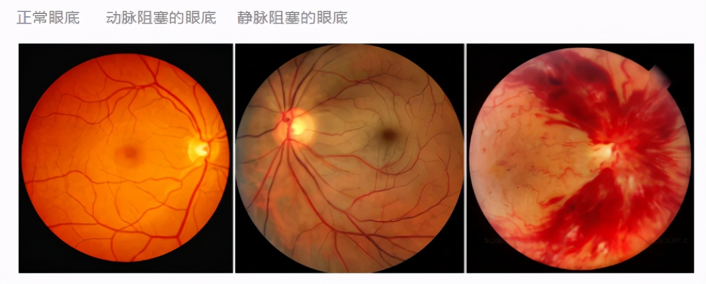 1/5老年人群存在眼底异常!专家:这一举措或有效缓解失明危机