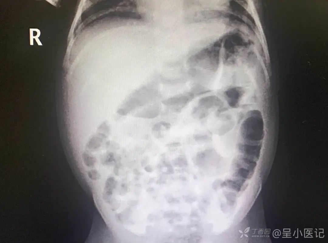 新生儿频繁呕吐胃肠减压抽出墨绿色胃液如何诊断