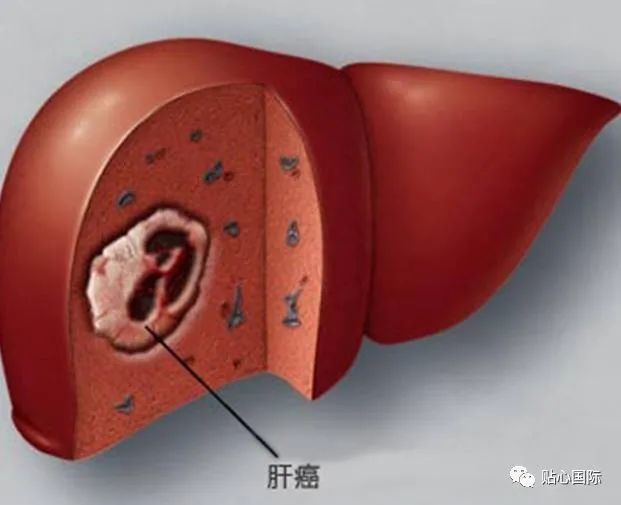 肝癌早期通过手术是可以治愈的,那为什么还有那么多人无法及时发现呢?