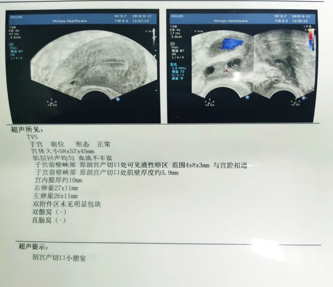 因为头大的老公我子宫里有了个小坑