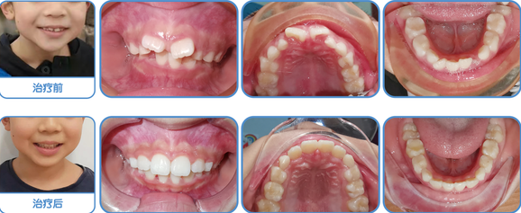 罗慕医生张冬梅儿童牙齿早期矫正需要有早矫逻辑做支持