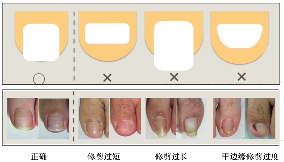 治疗嵌甲的方法有很多种,主要的治疗方式还是取决于嵌甲的严重程度