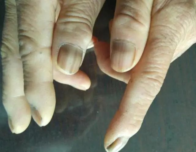 2,指甲发黑这是因为,肺部受损,其内部会堆积毒素,当毒素超过自身代谢