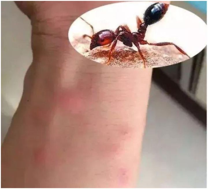 1,蚂蚁咬人时,会留下蚁酸,致使皮肤发痒,而肥皂水能起到中和作用,所以