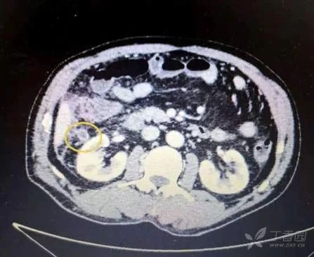 复查增强全腹 ct:阑尾可疑高位伴周围肠系膜渗出,考虑急性阑尾炎可能