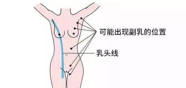 1,完全型副乳:与正常乳房一样有完整乳腺,乳头和乳晕,会随着月经来潮