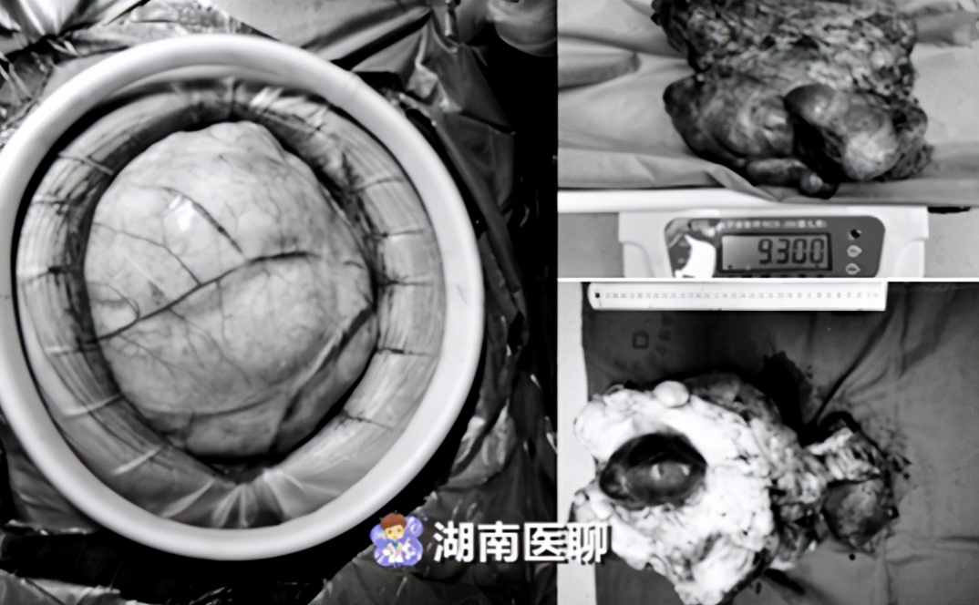 活久见!男子腹膜后藏19斤大肉瘤,医生7小时手术成功"排雷"