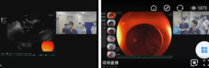 电子直肠镜怎么做做了肠镜等于白做？短期发生癌症，首诊漏检占 52%_https://www.jmylbn.com_新闻资讯_第3张