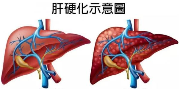 肝硬化的4种典型症状,快看看你中招没?__凤凰网