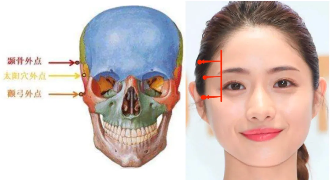 由于太阳穴凹陷使得颧骨成为了面部的最宽处,改善这一点就需要增加