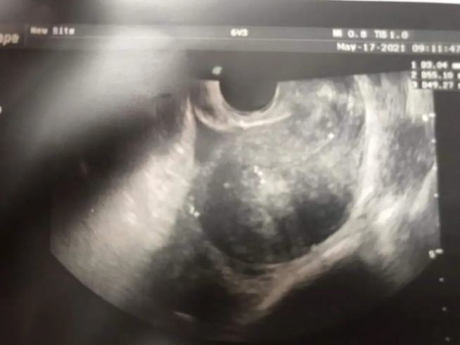 点击接好孕家恩德运严重子宫腺肌症患者成功圆梦