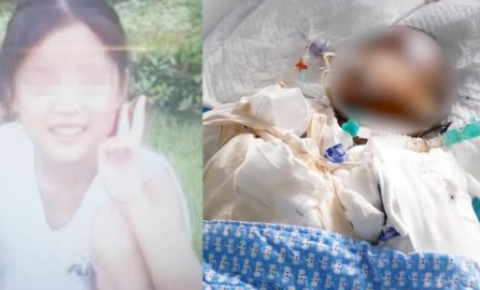 女孩模仿短视频易拉罐自制爆米花 被严重烧伤