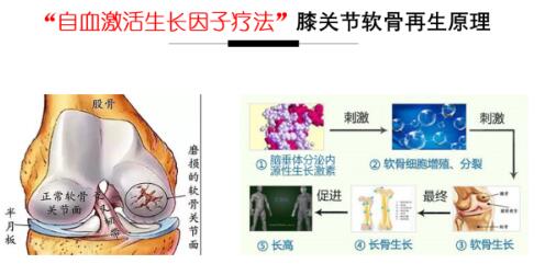 北京时珍堂中西医结合医院采用自血修复再生因子治疗骨膝关节疾病