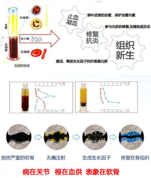 北京时珍堂中西医结合医院采用自血修复再生因子治疗骨膝关节疾病