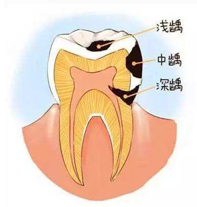 牙齿龋坏到需要做根管治疗?你还在这样护理牙齿吗
