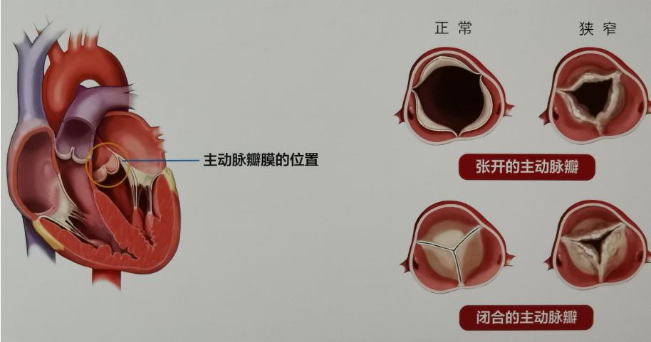 在2002年以前,外科主动脉瓣置换术是唯一可以延长生命的治疗手段.