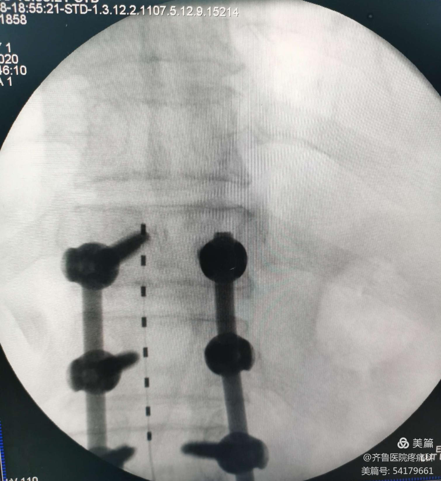 腰椎术后顽固性疼痛患者术后x线检查电极位置良好