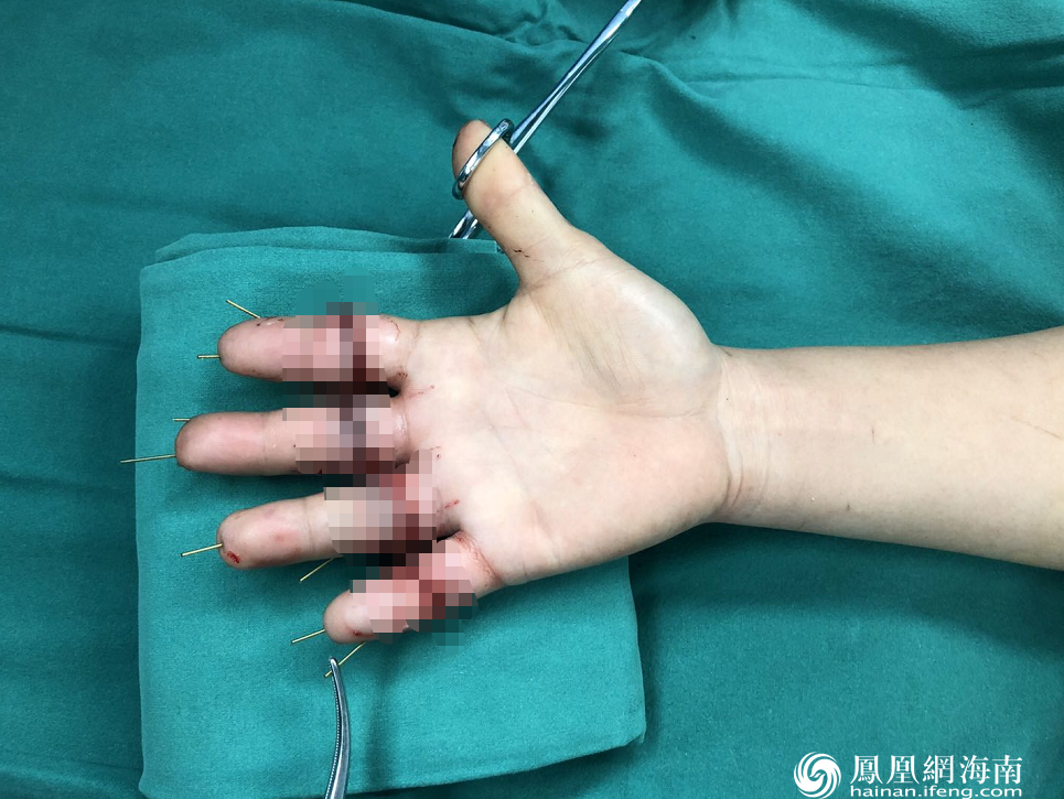 手指 手足 外科 患者 右手 团队 血管 通宵|经过海医二院手术团队一个通宵努力 折弯机离断四指一一再植成功