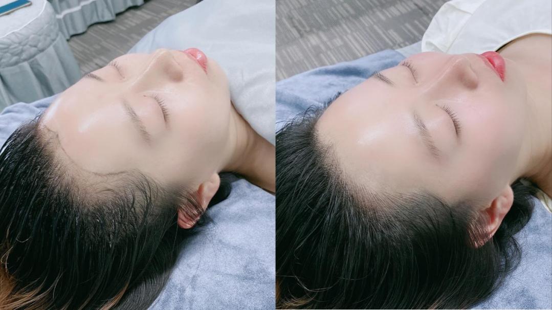 毛囊 发际线 干细胞 头发 碧缇美业 男士 细胞 阿里健康 头顶 美业|碧缇美业：发际线（退）总是在和我作队其实不是发际线在后退 而是你的人生需要前进