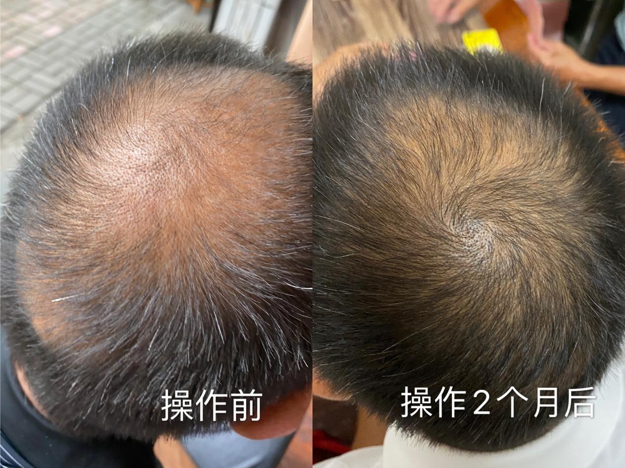 毛囊 发际线 干细胞 头发 碧缇美业 男士 细胞 阿里健康 头顶 美业|碧缇美业：发际线（退）总是在和我作队其实不是发际线在后退 而是你的人生需要前进