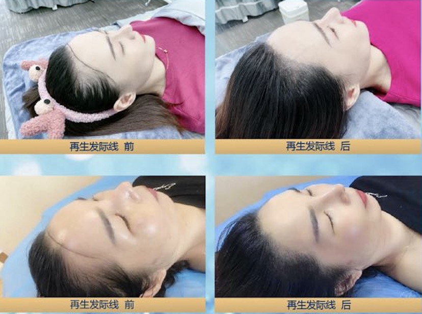 毛囊 发际线 干细胞 头发 碧缇美业 男士 细胞 阿里健康 头顶 美业|碧缇美业：发际线（退）总是在和我作队其实不是发际线在后退 而是你的人生需要前进