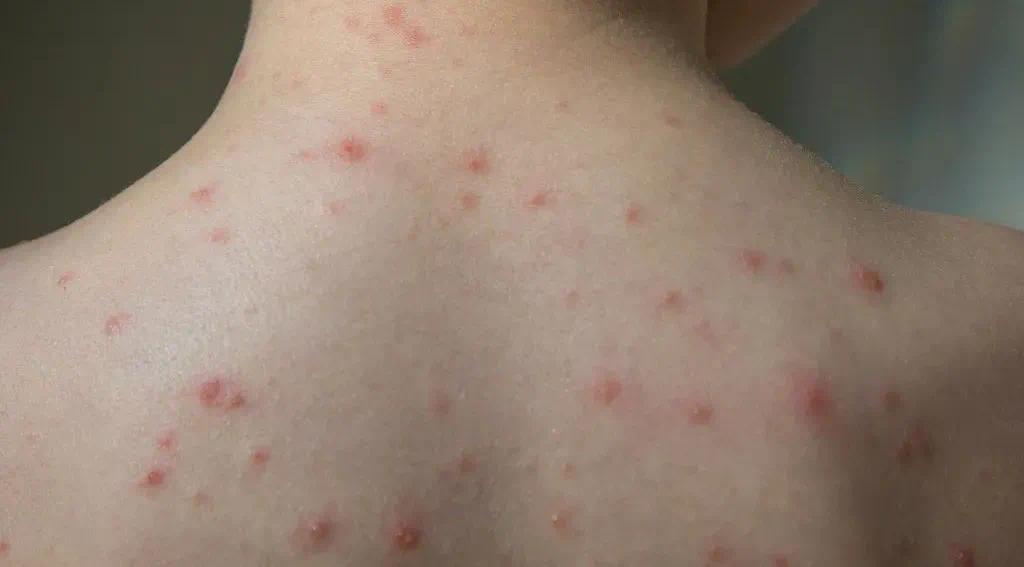 水痘进入高发期多地已停课专家介绍如何预防