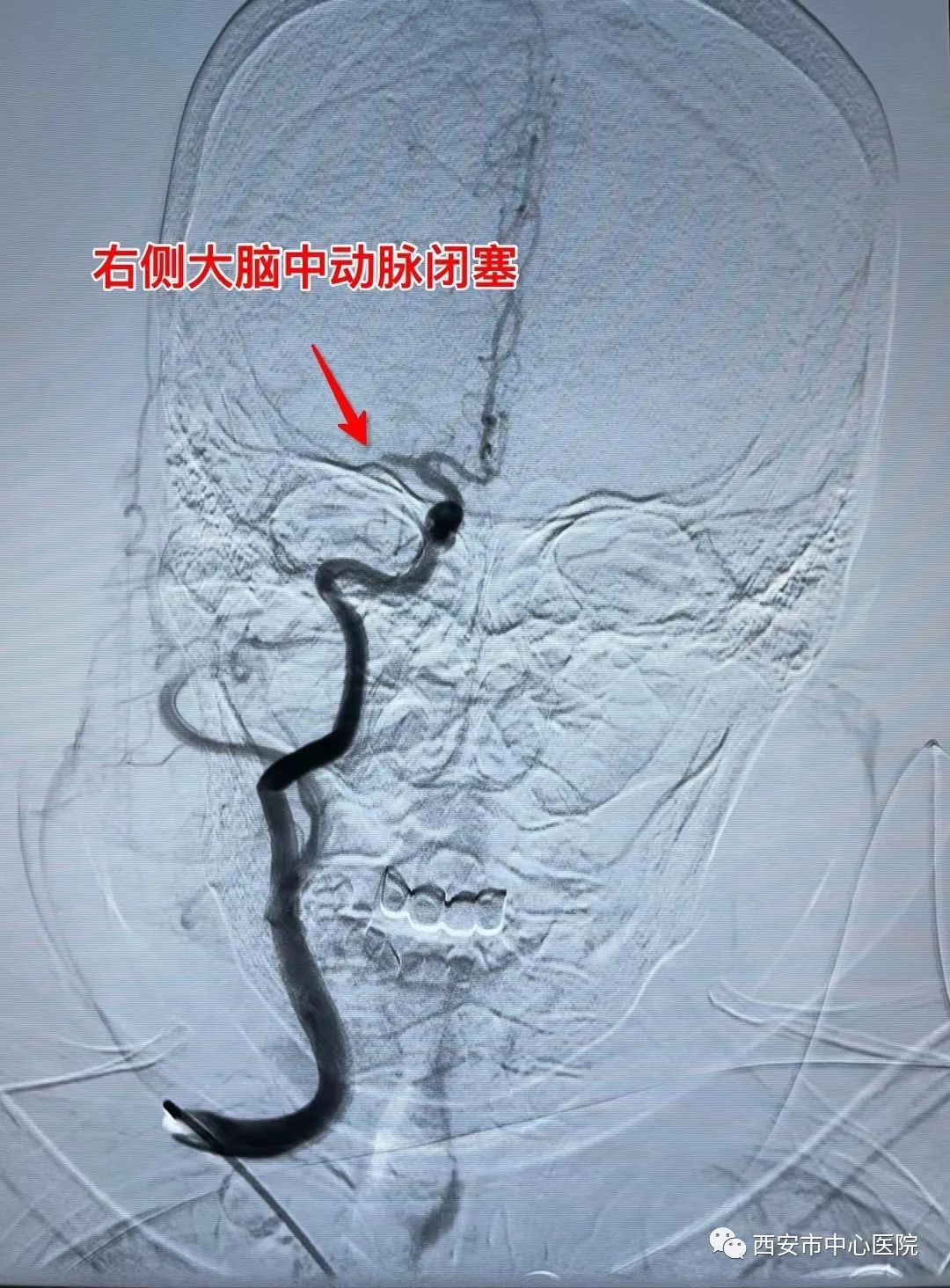 西安市中心医院:医生妙手取出致命血栓让老人转危为安