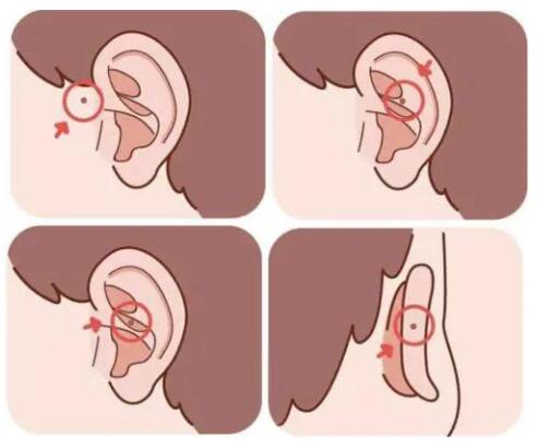 成都民生耳鼻喉提醒:耳朵上有小洞不要挤!这可能是耳前瘘管