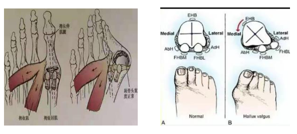 ③第一跖趾内侧关节囊松弛,外侧关节囊挛缩,跖骨间横韧带松弛,踇内收