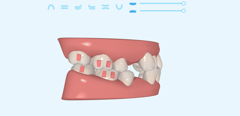 这次寒假回来复诊才发现口腔科牙齿矫正有活动,不仅活动期间矫正牙齿