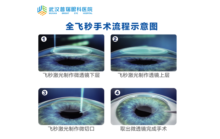 激光近视手术怎么选武汉普瑞眼科医院全飞秒手术备受青睐