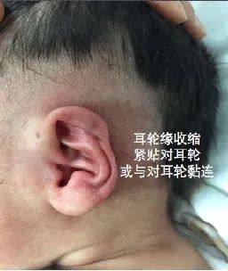 健康养生 健康资讯 正文 杯状耳:耳廓前倾类似招风耳,耳舟及三角窝