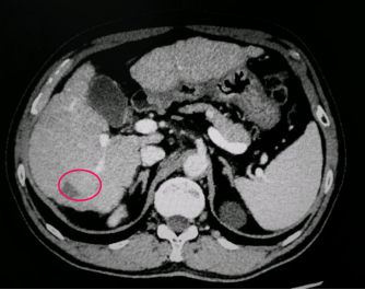 月在西京医院上腹部增强ct提示:肝内占位性病变,结合病史符合肝癌表现