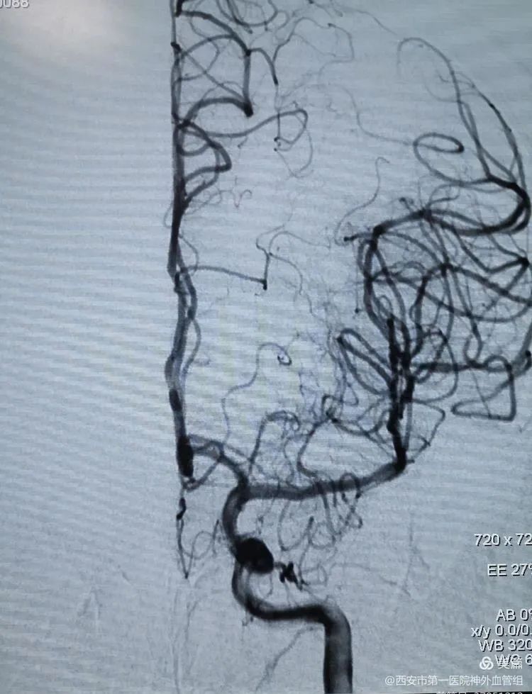 西安市一院神外血管组介入病例系列9——轻症脑血管闭塞