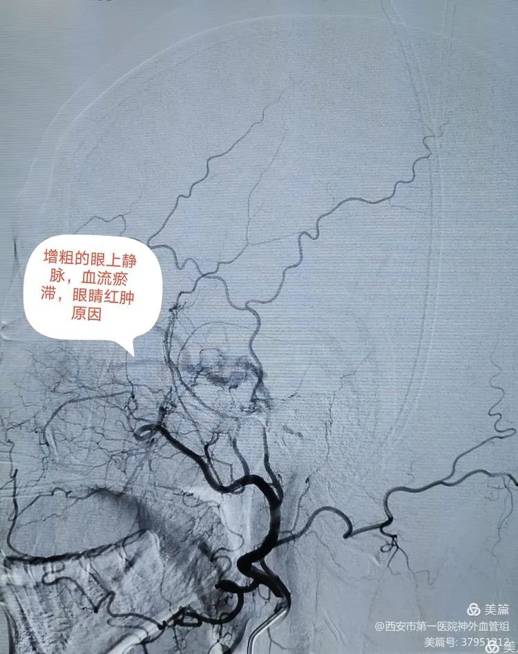 左侧颈外动脉主供血