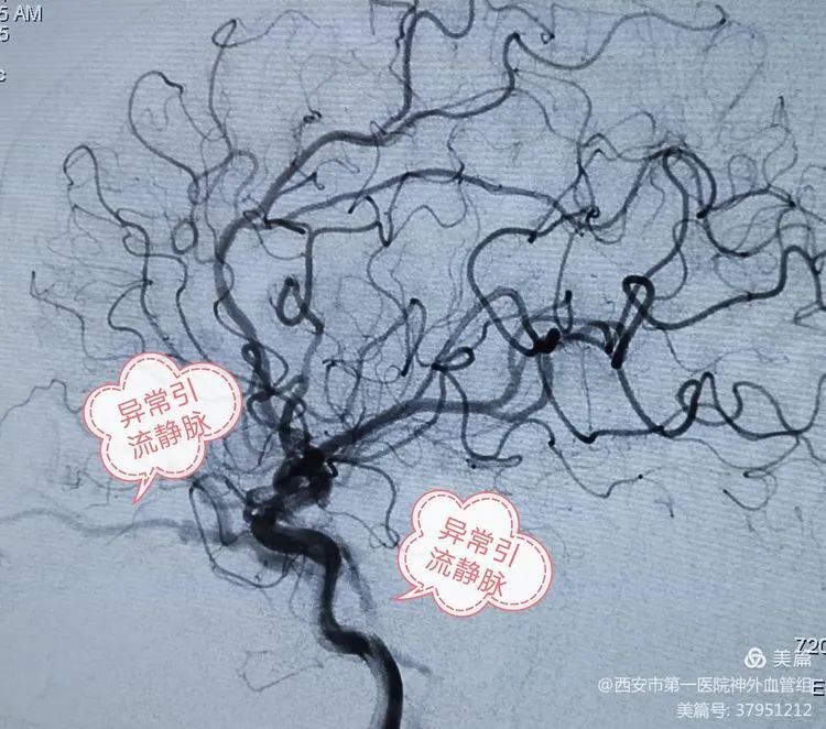 西安市第一医院神外介入病例10——介入治"红眼"