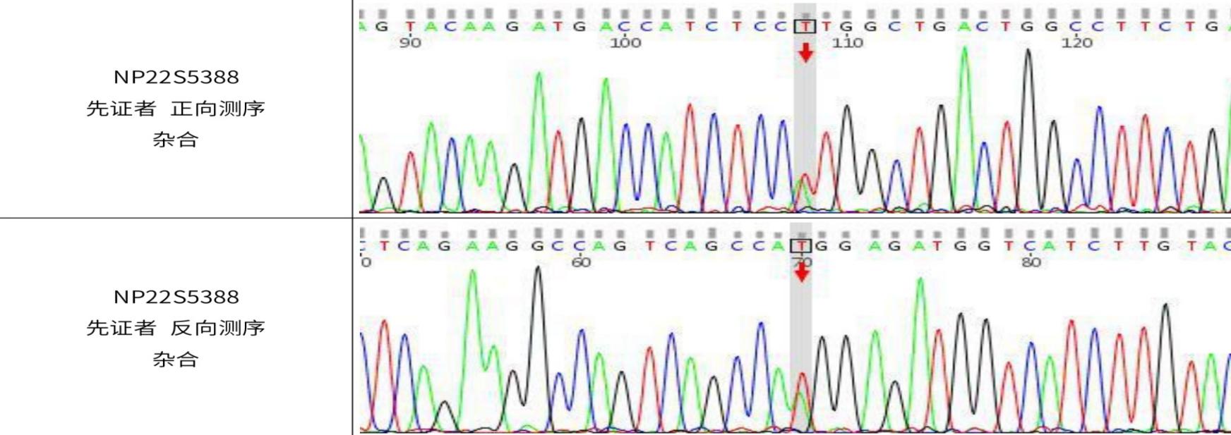 结果及双向测序峰图为明确诊断,匡洪宇教授团队对孟女士进行基因检测