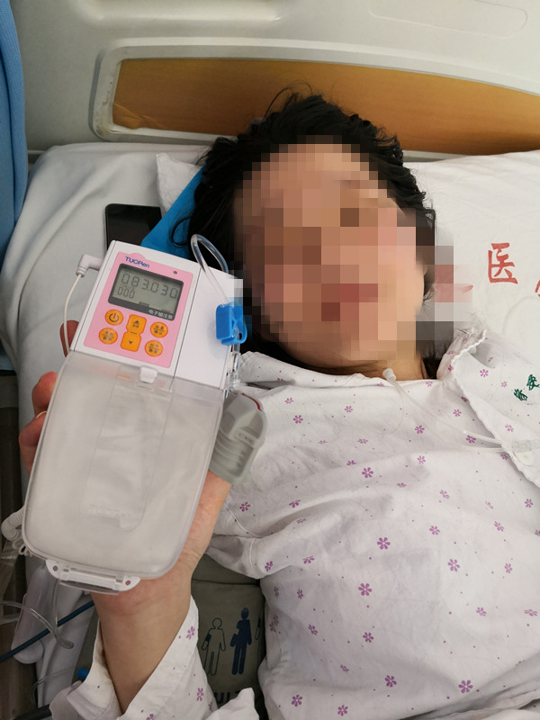 凤眼观楚 正文 武汉市第四医院一产妇实施了分娩镇痛后,拿着镇痛泵